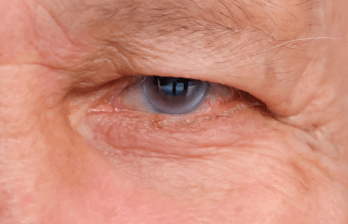 Glaucoma